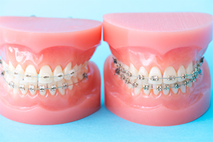 歯列矯正とは？